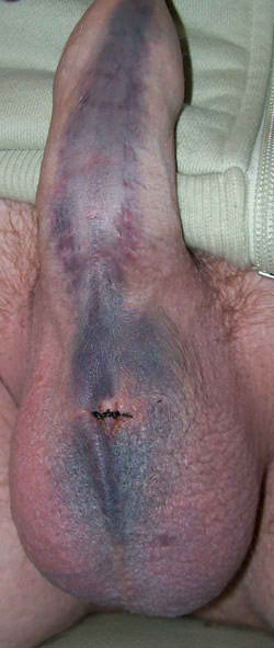 Bruised Penis After Sex 27